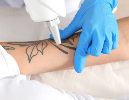 Combien de séances sont nécessaires pour supprimer un tatouage au laser ? | Centre du Champ de Mars | Paris