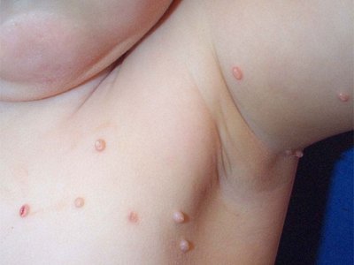 molluscum contagiosum